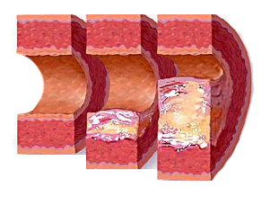 Атеросклероз